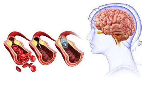 腦卒中和腦梗塞的區(qū)別